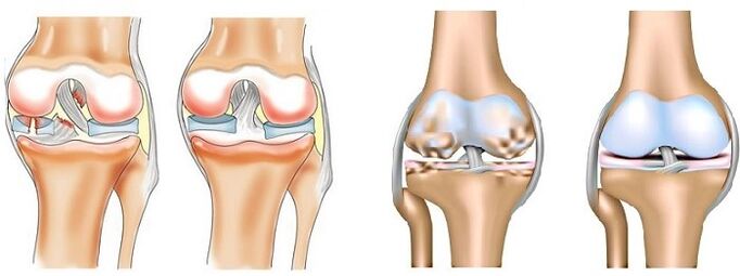 Mi az ízületi gyulladás és arthrosis